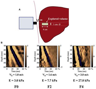 Correlation Between Liver Stiffness and Diastolic Function, Left Ventricular Hypertrophy, and Right Cardiac Function in Patients With Ejection Fraction Preserved Heart Failure